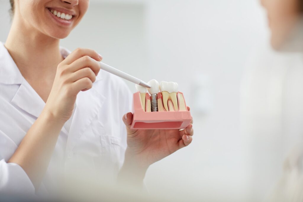 Dental Implants: What to Know?